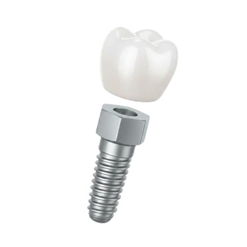 Best Dental Implants Ahmedabad